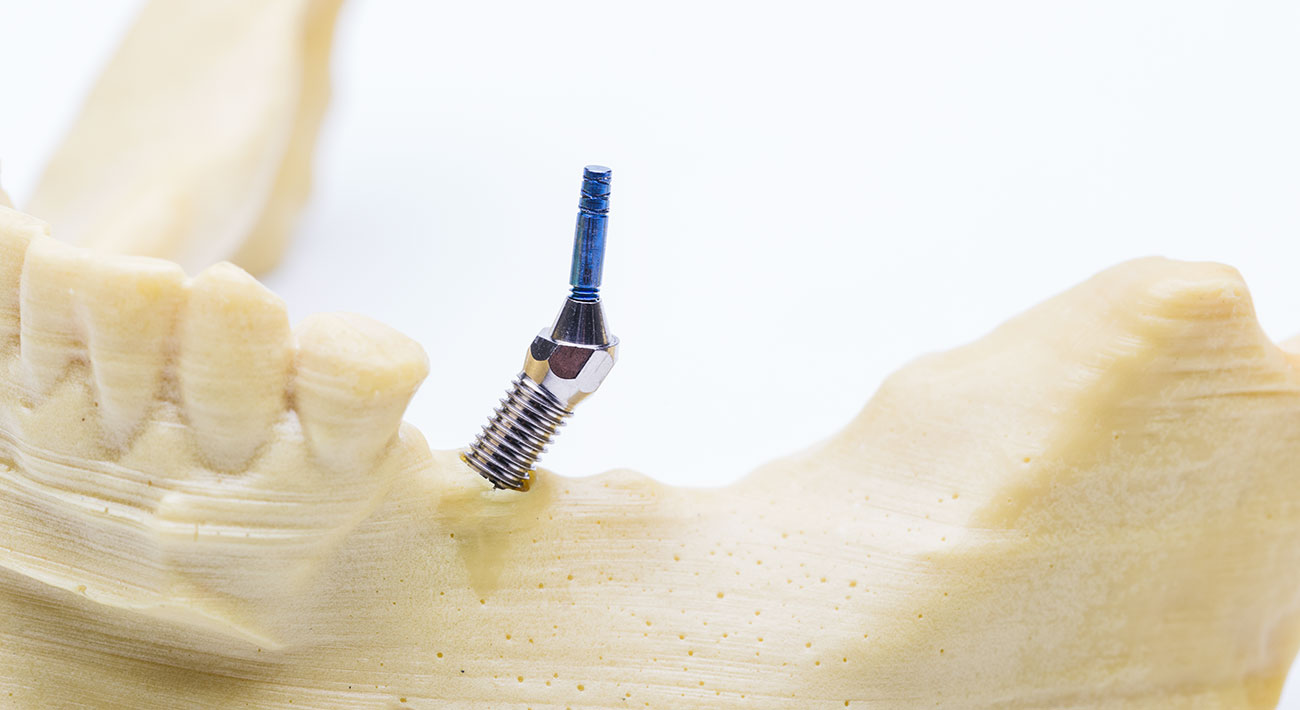 Agliati Implantologia | Implantologia dentale