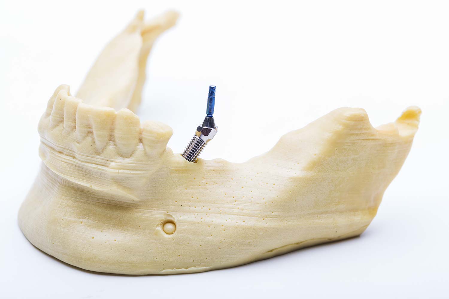 Agliati Implantologia | Modelli 3D