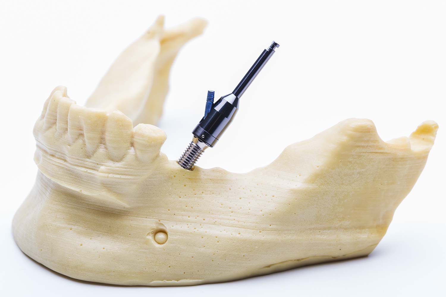 Agliati Implantologia | Strumenti di precisione